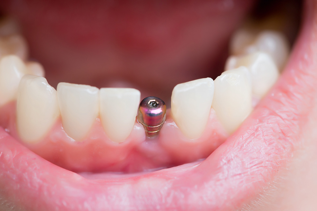 open mouth with implant showing what are dental implants