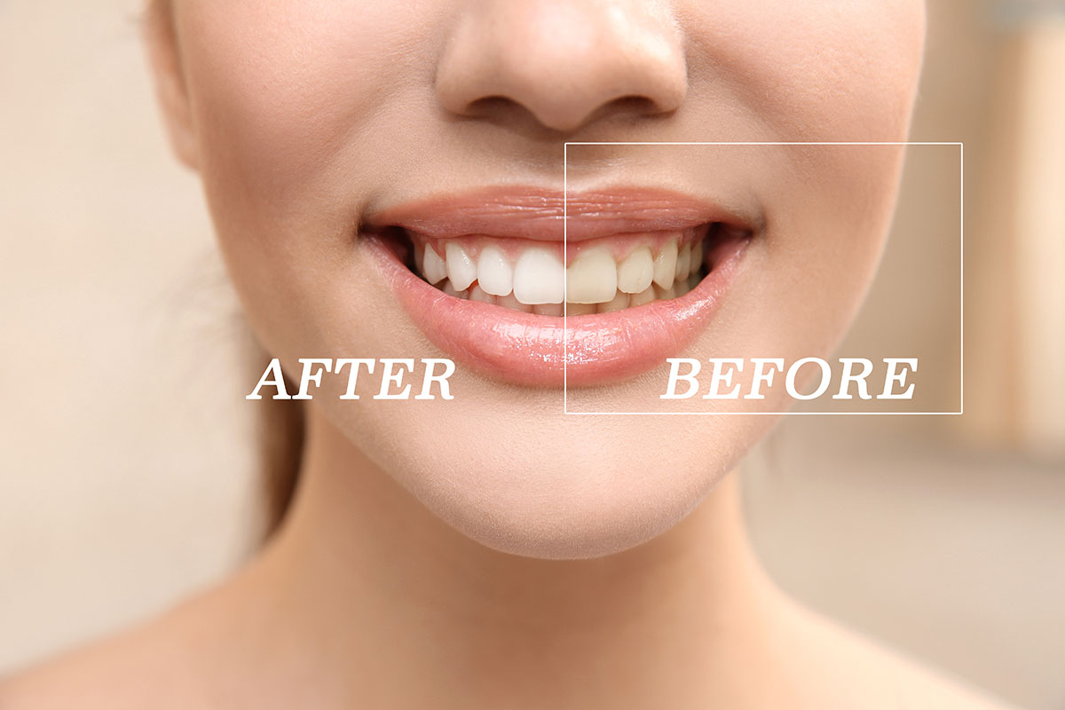 what is teeth whitening before and after of Teeth Whitening