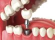 example of a single tooth implant