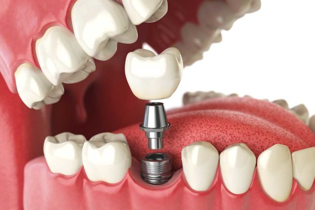 3-What-is-a-Single-Tooth-Implant (3) example of a single tooth implant