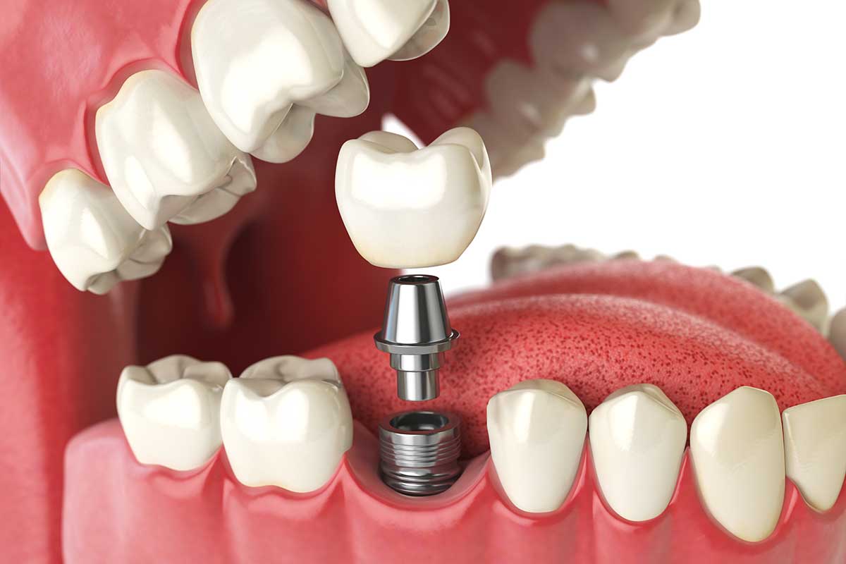 3-What-is-a-Single-Tooth-Implant (3) example of a single tooth implant
