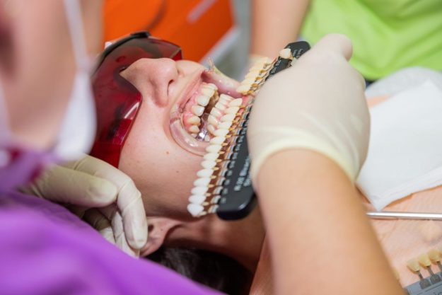 dental veneers