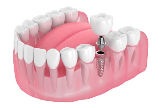 dental implants